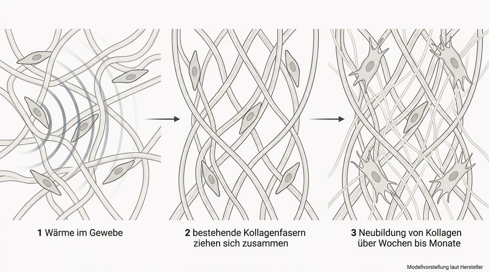 Schematische Darstellung in drei Stufen: Wärme im Gewebe, bestehende Kollagenfasern ziehen sich zusammen, Neubildung von Kollagen über Wochen bis Monate.